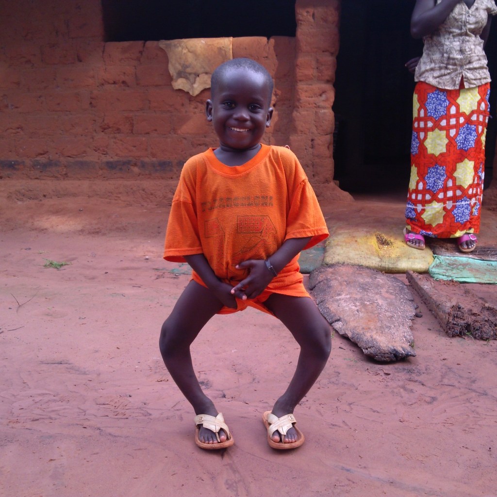 Así eran las piernas de Sam antes de su operación